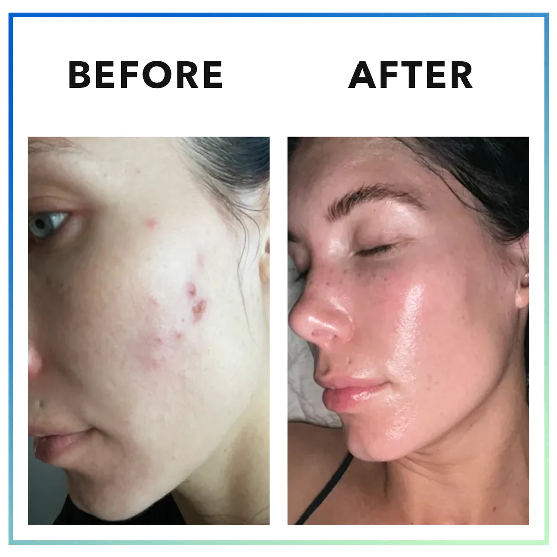 MINDBODYSKIN™ Hormonal Acne Supplement